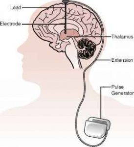 Deep brain stimulation (DBS) for Parkinson’s Disease – The Operating ...