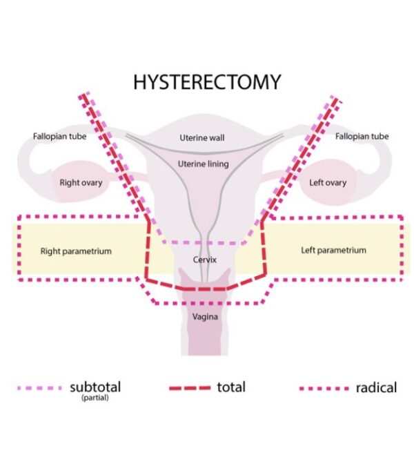 What you can expect after Hysterectomy – The Journey to Recovery – The ...