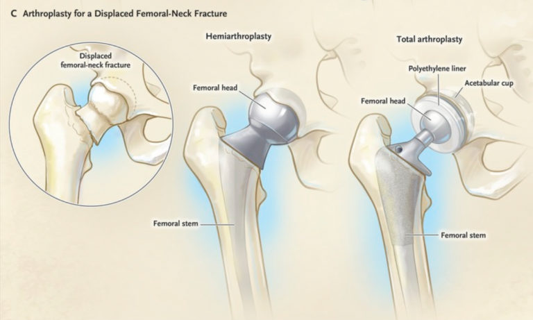 hip-hemiarthroplasty-what-you-need-to-know-the-operating-room